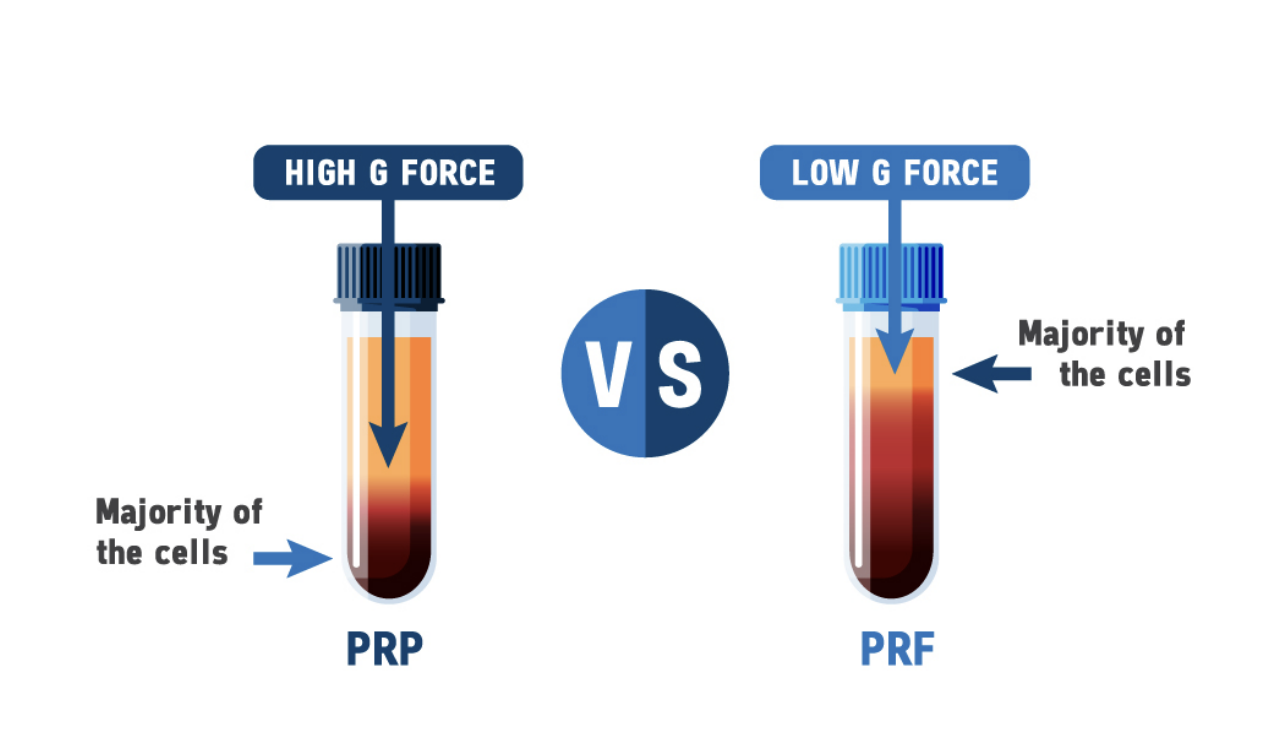 Platelet Rich Fibrin Prf Procedure For Hair Restoration And Skin